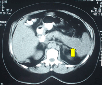 Imagen de un tumor de páncreas